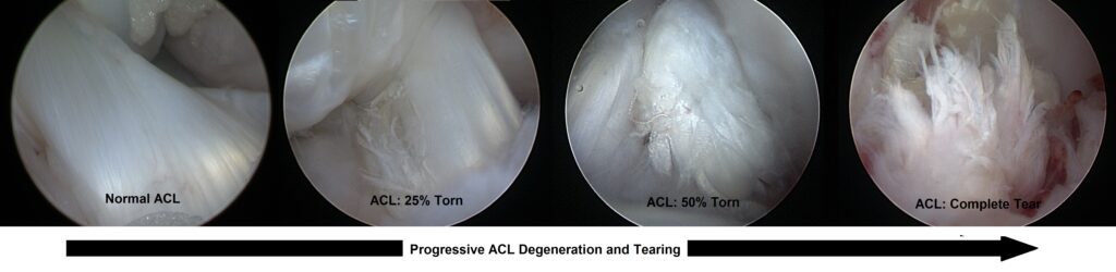 ACL Series 3